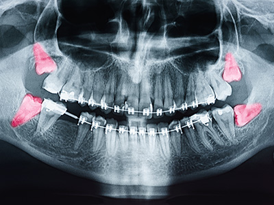 Saugeen Shores Family Dentistry | Implant Dentistry, Botox reg  and Oral Cancer Screening